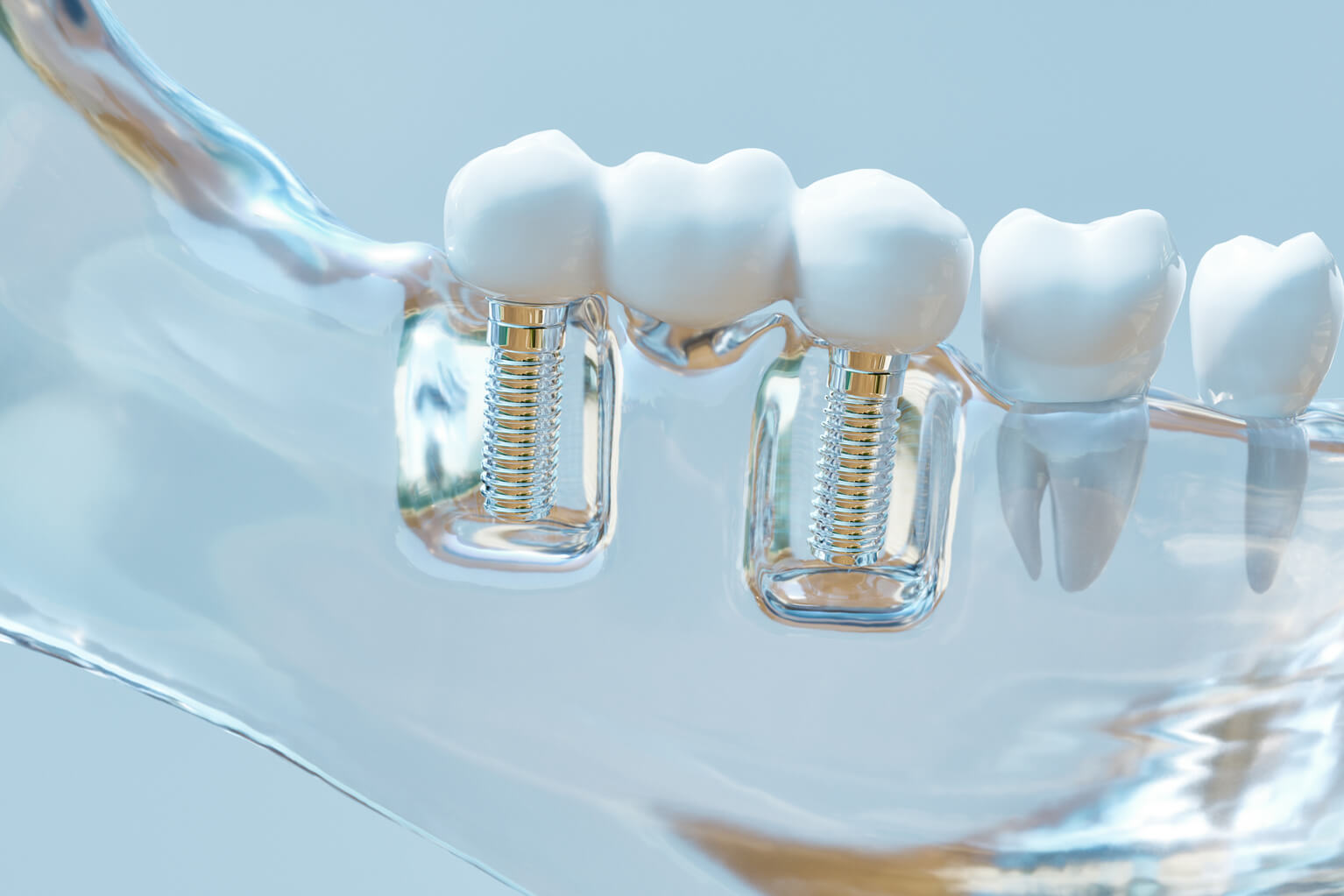 3D Rendering of Tooth human implant